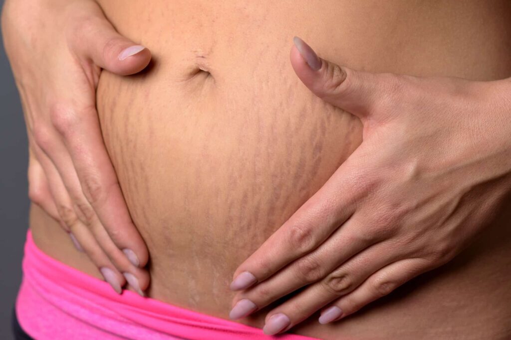 Rozstępy, które powstały w wyniku ciąży